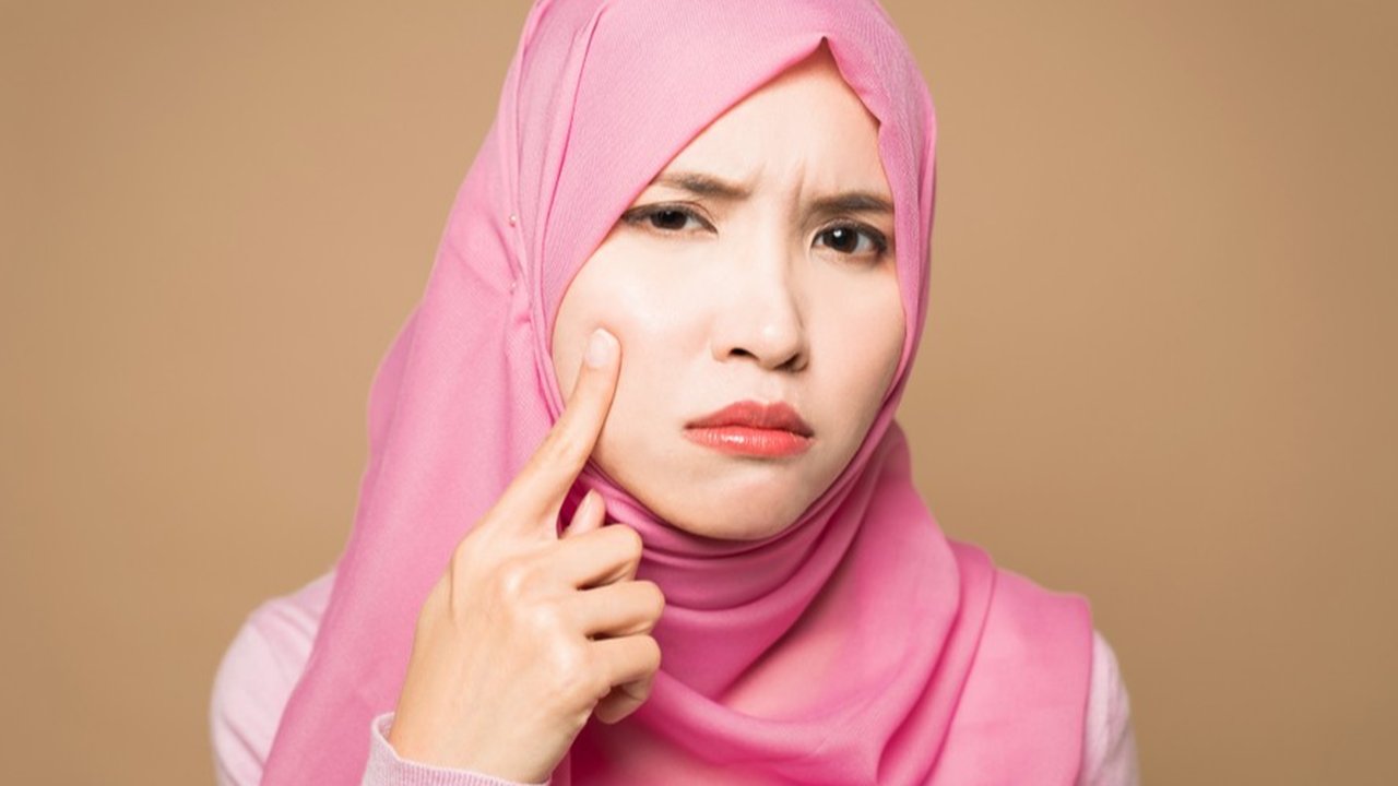 Mitos Jerawat yang Banyak Berkembang, Ketahui Pula Faktanya