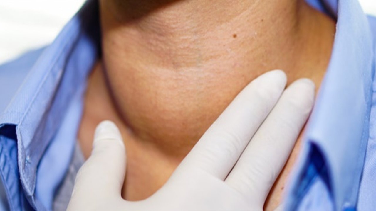 Ganggu Kesehatan dan Penampilan, Ini 7 Cara Mengatasi Gondongan Secara Alami