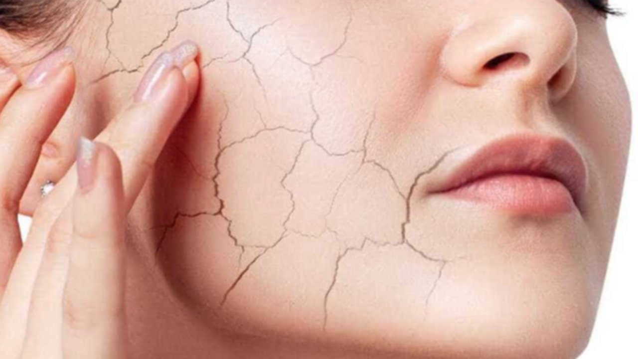 Jangan Biarkan Kulit Kering Mengganggu! 6 Tips Ampuh Atasi Kulit Kering Saat Musim Dingin