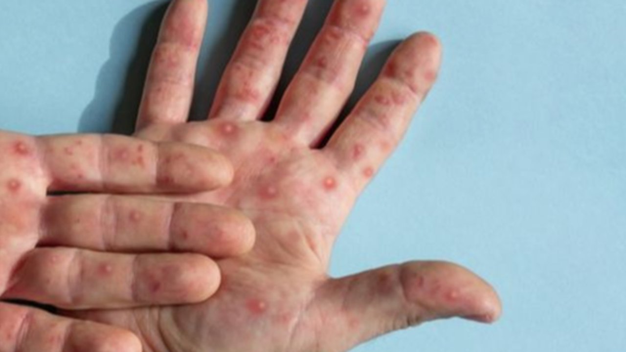 Monkeypox Masuk Indonesia, 4.450 Vaksin Disiapkan