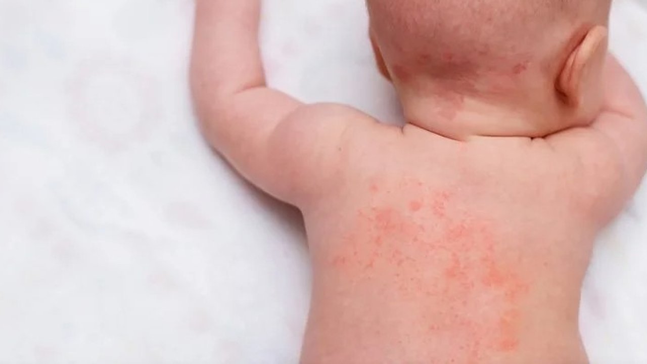 Cara Mengatasi Biang Keringat pada Anak secara Alami