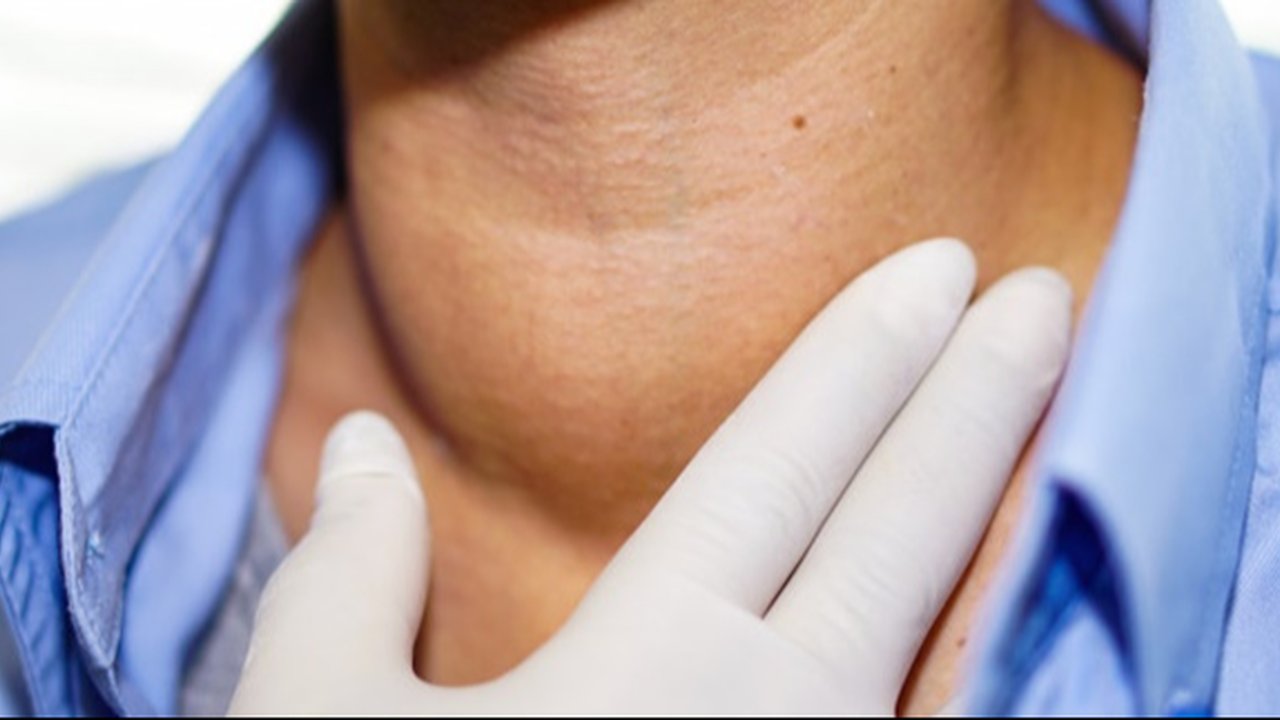 Ganggu Kesehatan dan Penampilan, Ini 7 Cara Mengatasi Gondongan Secara Alami