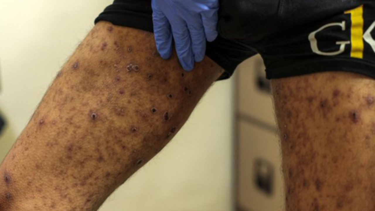 Tawanan Palestina yang Dibebaskan Israel Tunjukkan Tanda Bekas Penyiksaan dan Kelaparan