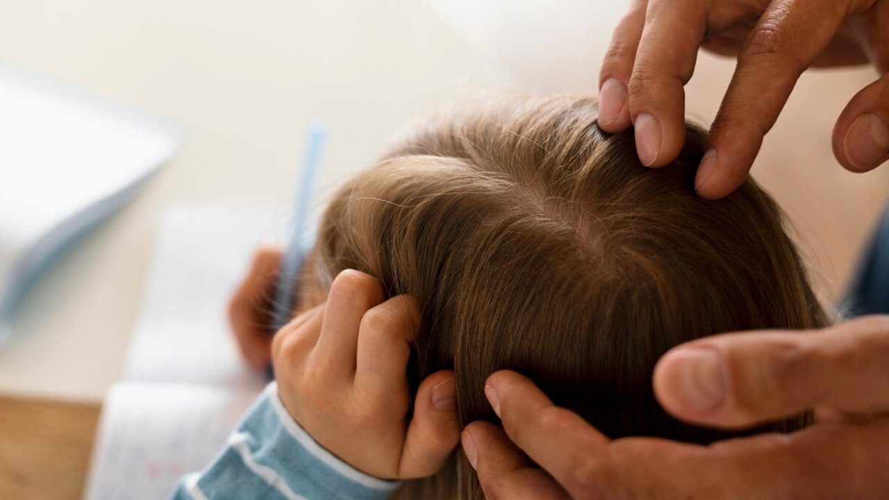 Say Goodbye to Kutu Rambut: Mengatasi Kutu Rambut dalam 5 Langkah