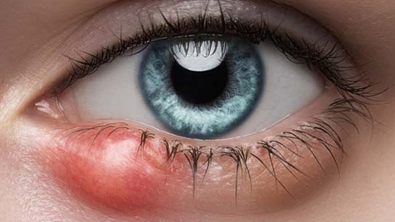 Cara Menghilangkan Mata Bintitan dalam Semalam: Panduan Lengkap dan Efektif