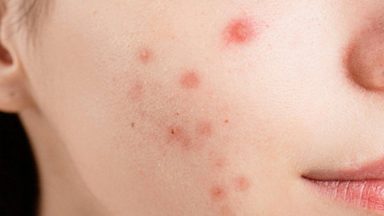 Doa Menghilangkan Jerawat dan Bisul, Acne Fighter Wajib Tahu!
