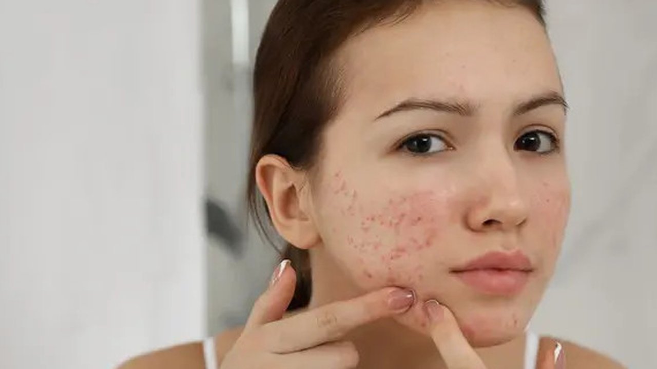 Ilustrasi Jerawat Whitehead | insider.com