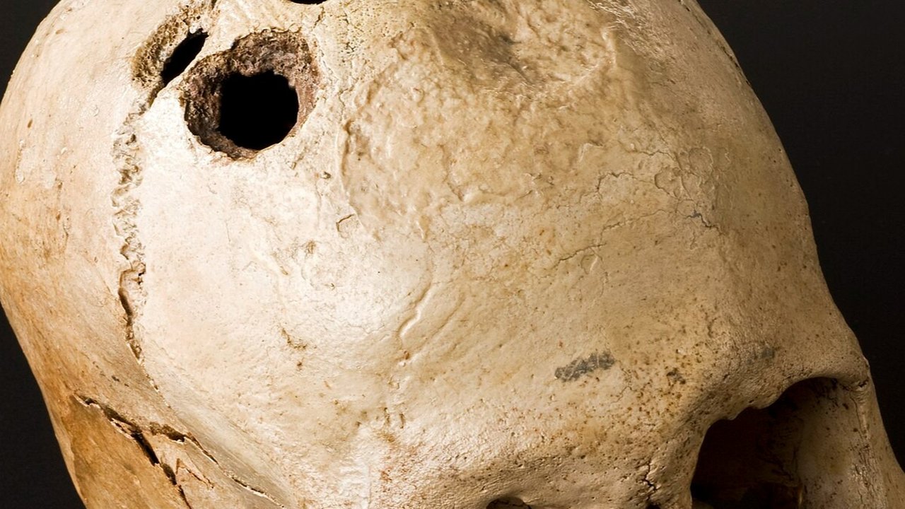 Trepanasi