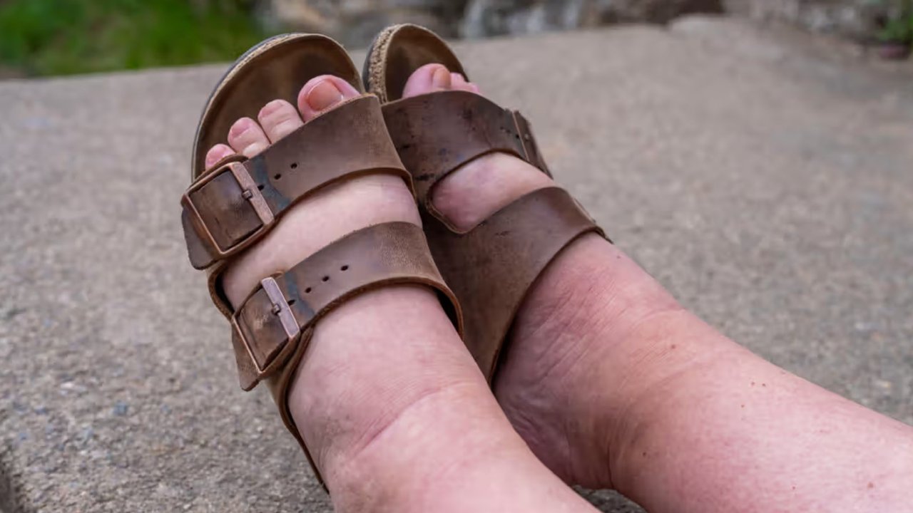 Ilustrasi kaki bengkak