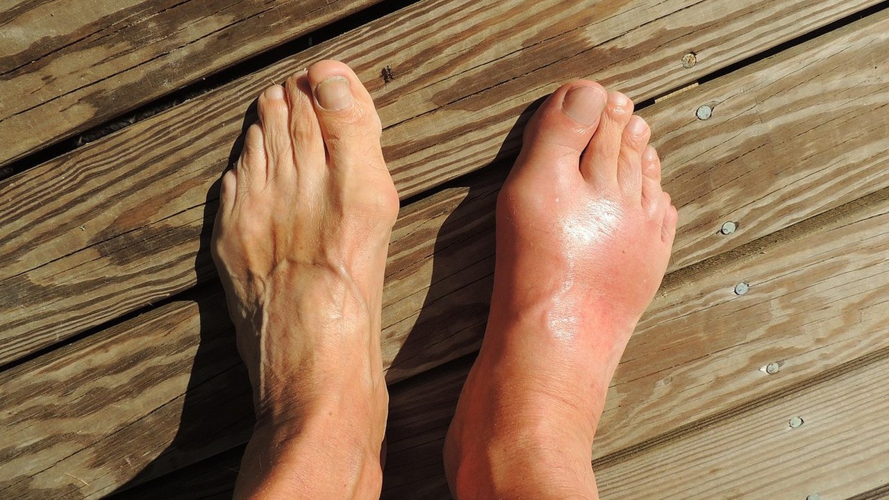 cara menghilangkan asam urat di kaki ©Ilustrasi cnick dari Pixabay