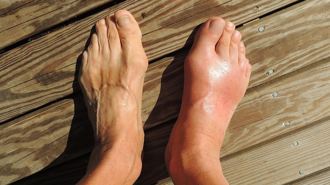 cara menghilangkan asam urat di kaki ©Ilustrasi cnick dari Pixabay