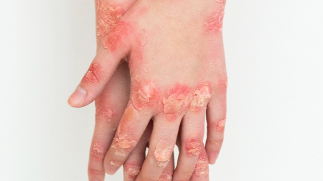 Eksim pada Orang Dewasa
