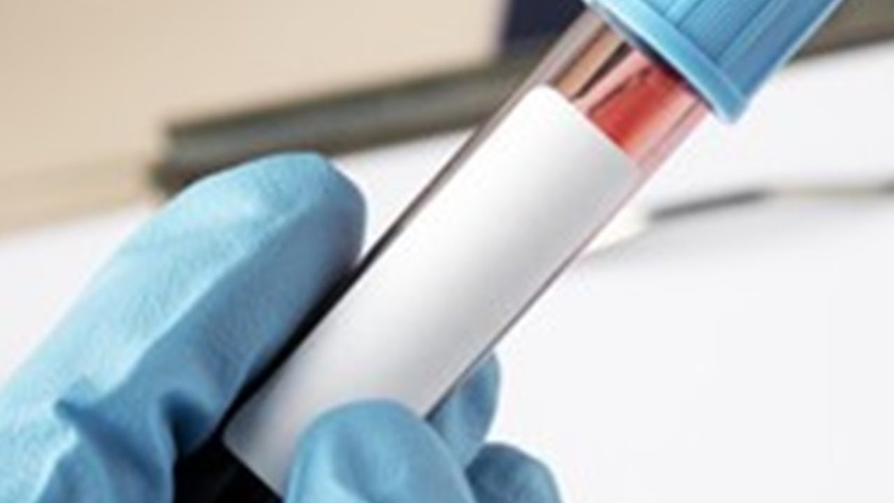 Kelebihan Sel Darah Putih, Ini 7 Tanda dan Risiko Penyakitnya