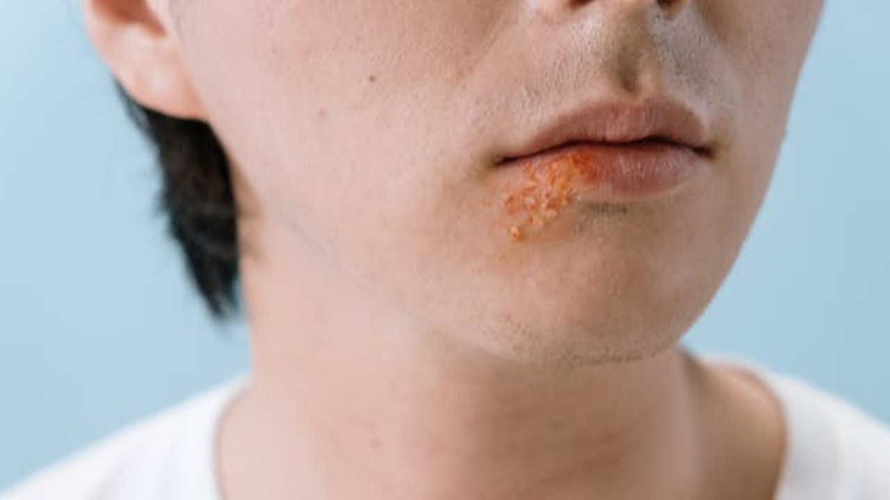 Herpes Genital Bisa Menyerang Siapa Saja, Begini Cara Mencegahnya