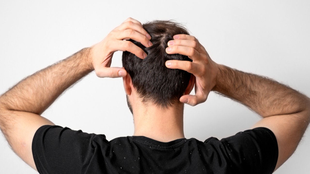 Cara Mengatasi Ketombe Membandel dengan Efektif