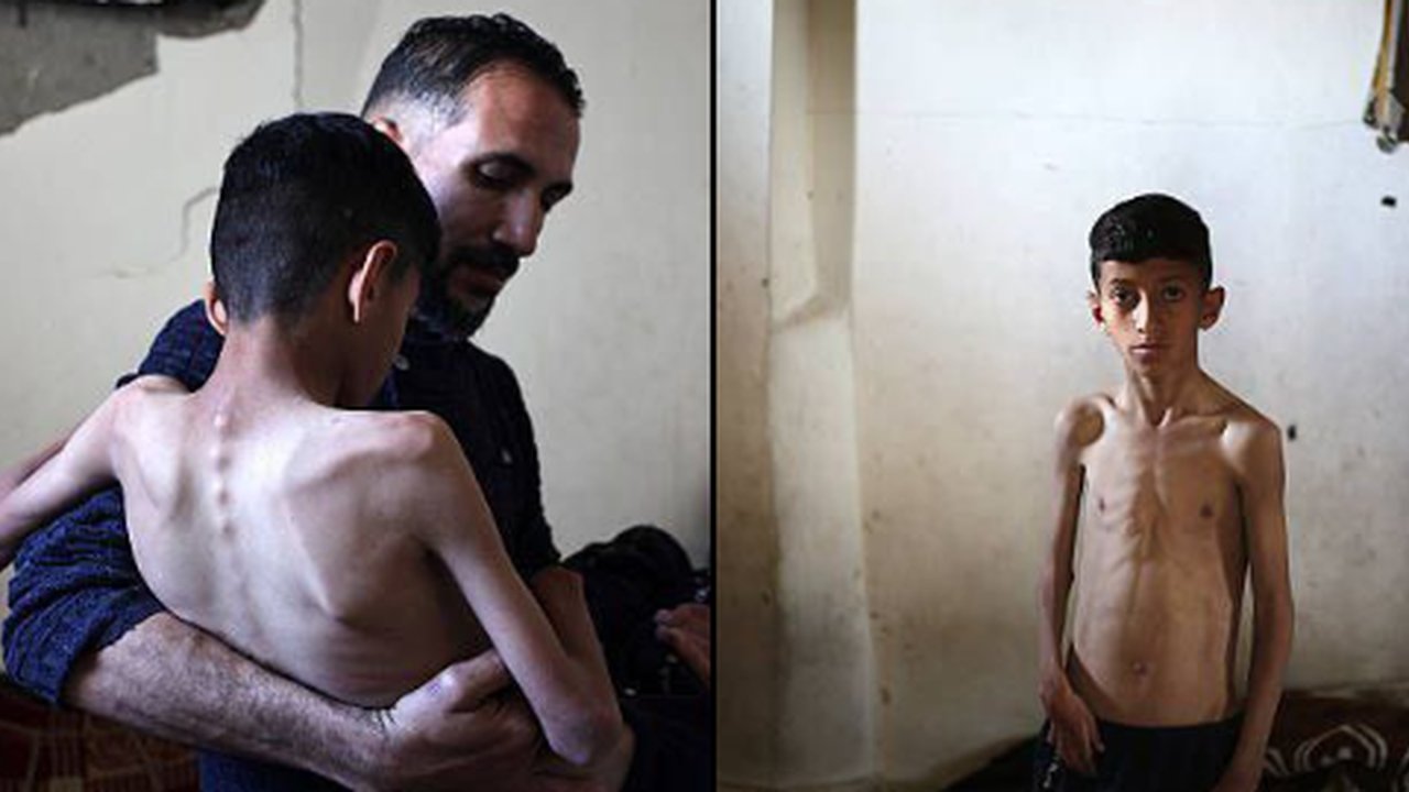 Anak di Gaza Alami Gizi Buruk