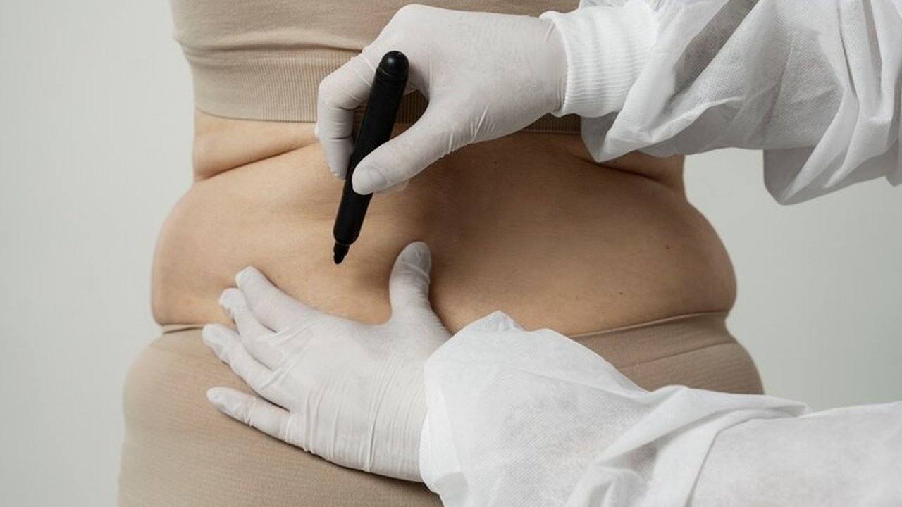 Ilustrasi Sedot Lemak