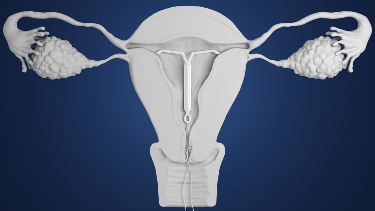 ilustrasi pemasangan IUD