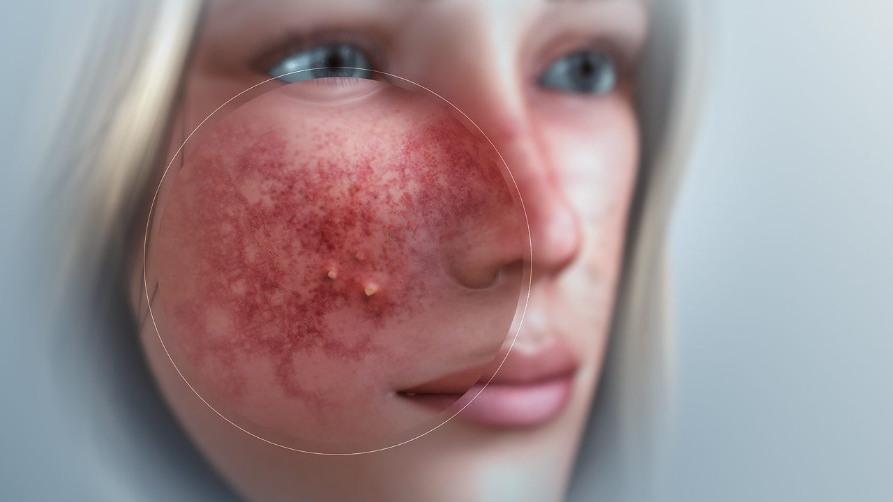 ilustrasi rosacea yang sering dianggap sama dengan jerawat