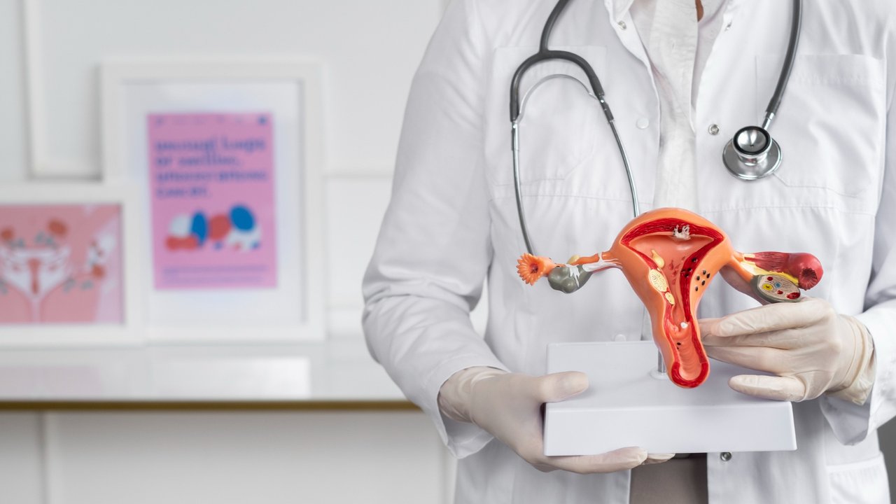 Ilustrasi Endometriosis