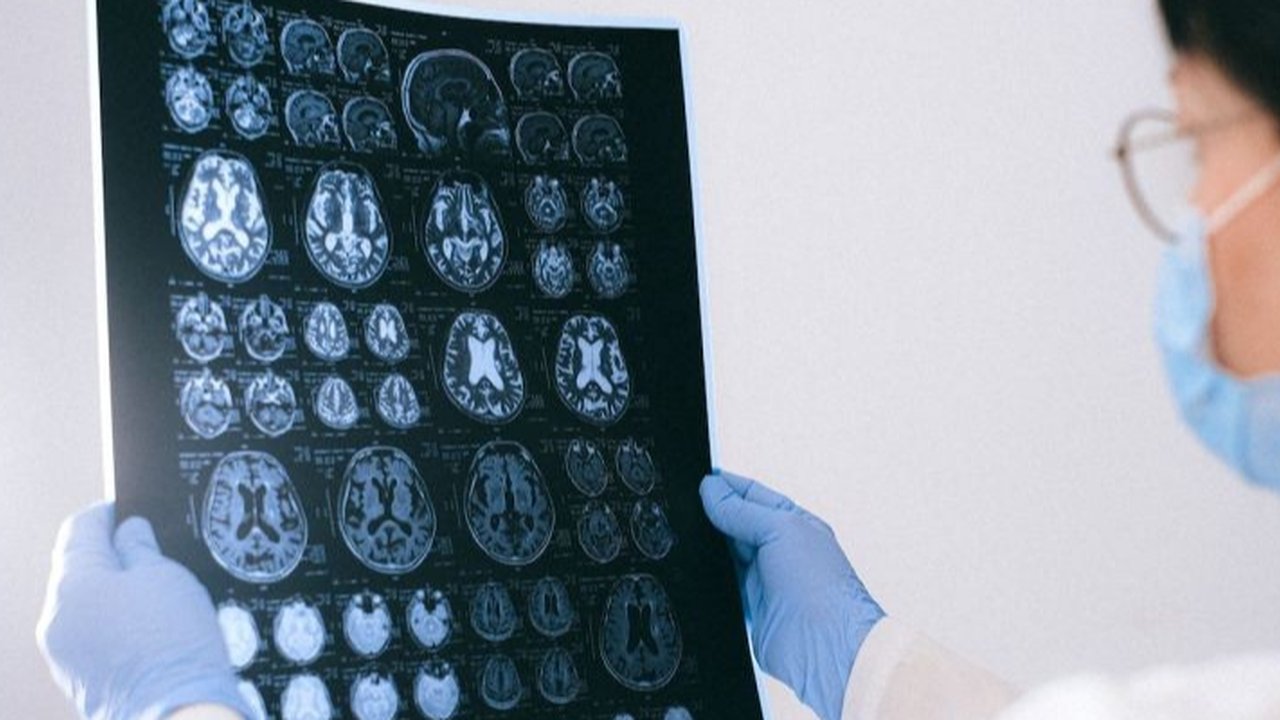 Ilustrasi gangguan pembuluh darah otak akibat stroke