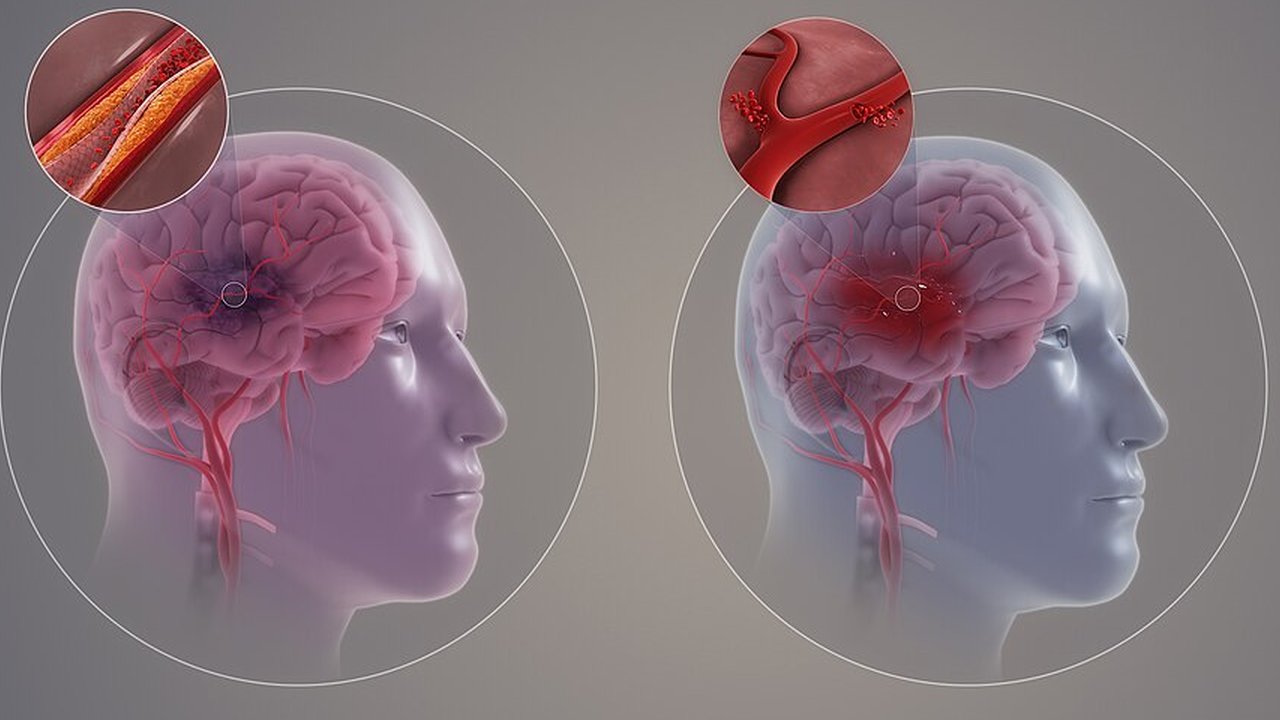 Ilustrasi Menangani Penderita Stroke