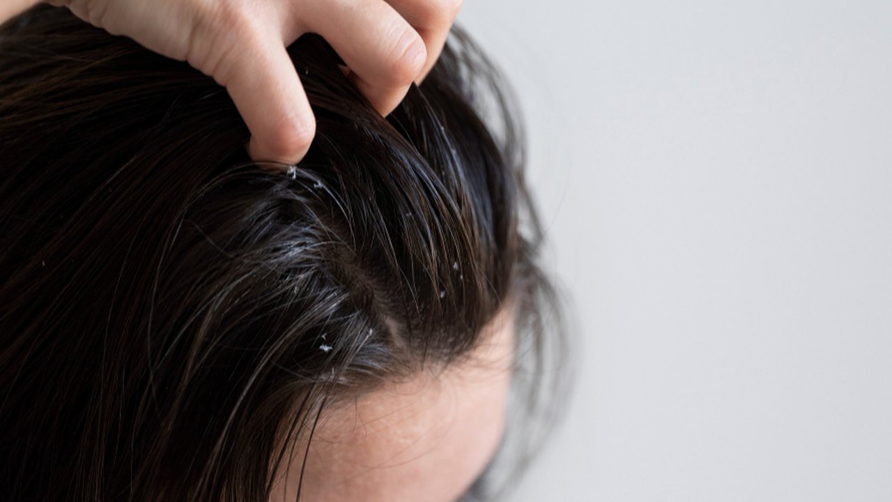Solusi Praktis untuk Rambut Berminyak dan Lepek
