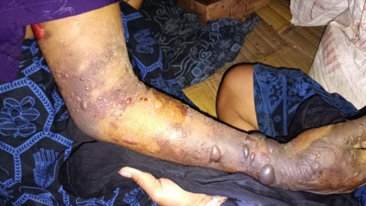 Serangan Ular Jenis Ini Gigit 28 Warga Badui, 2 Orang Meninggal