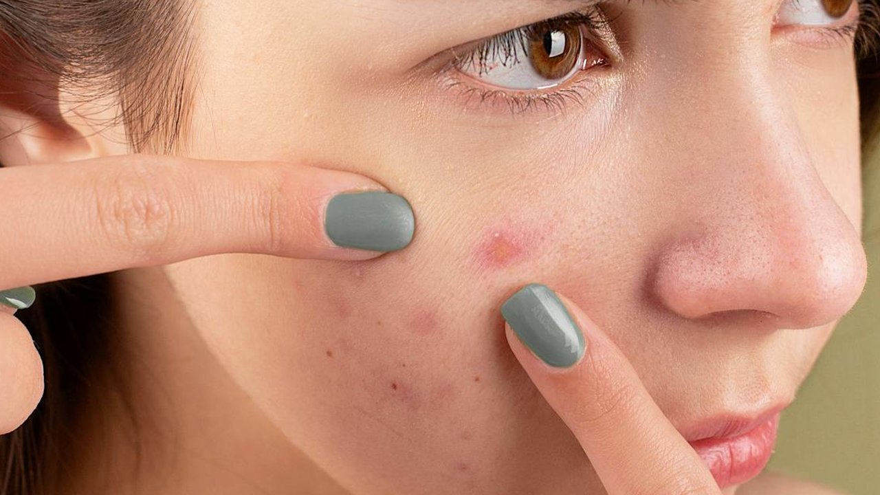 Ilustrasi Kulit Berjerawat