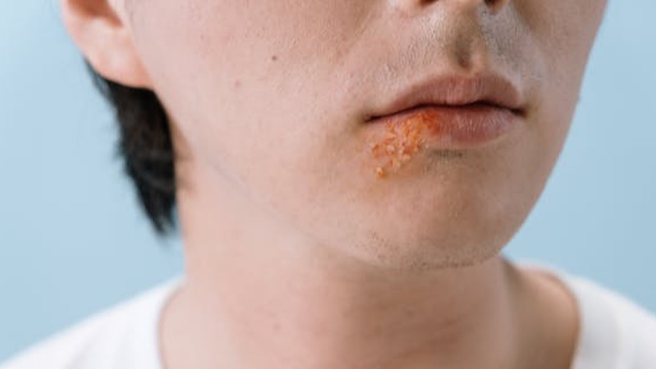 Herpes