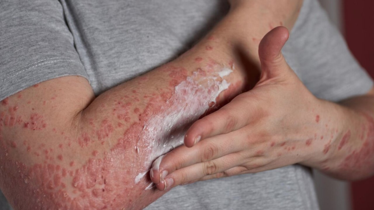 Steven Johnson Syndrome: Panduan untuk Pasien dan Keluarga dalam Proses Diagnosa