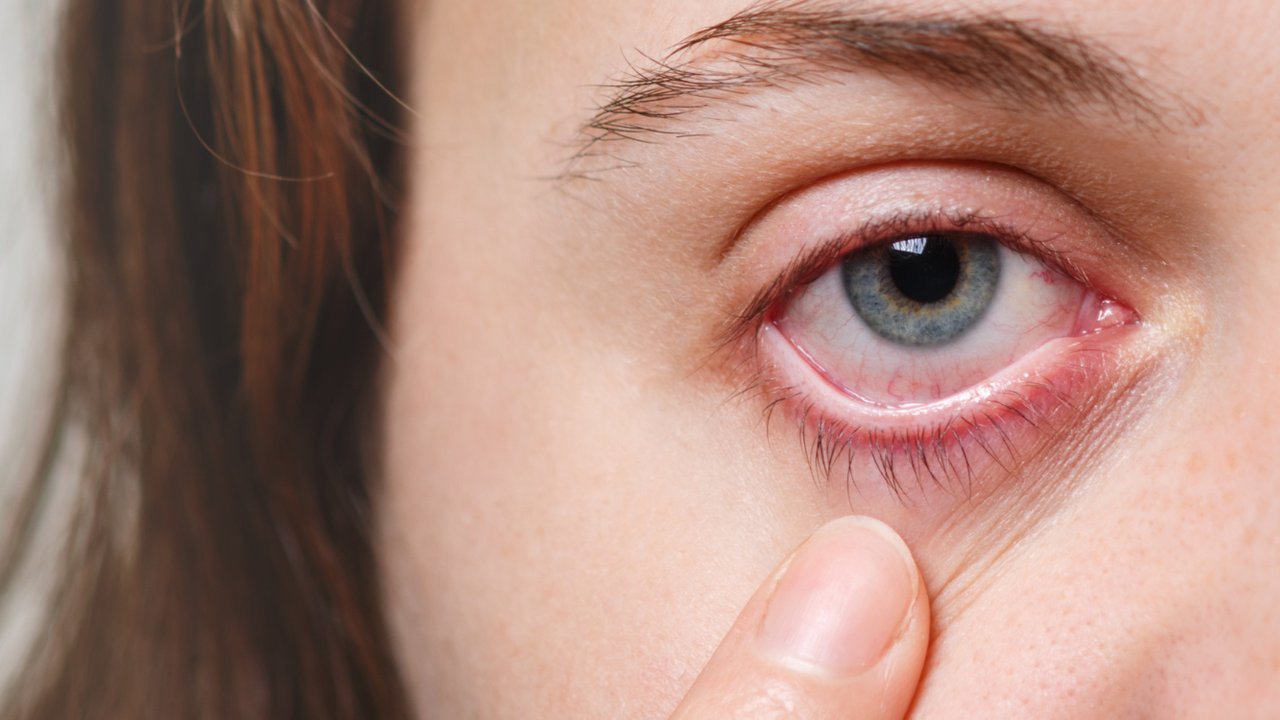 Ilustrasi Mata Merah (©Freepik)