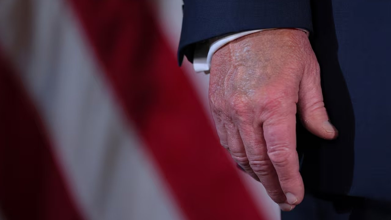 tangan trump bengkak