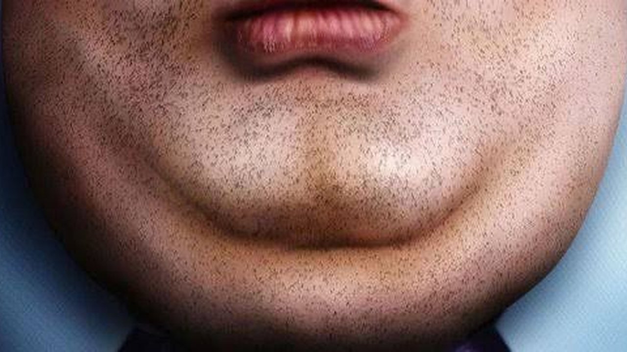 double chin