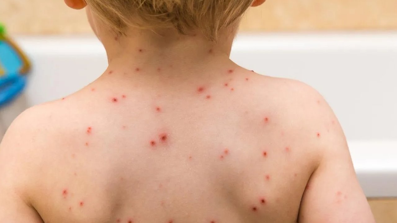 Kontak Langsung dengan Cacar Air