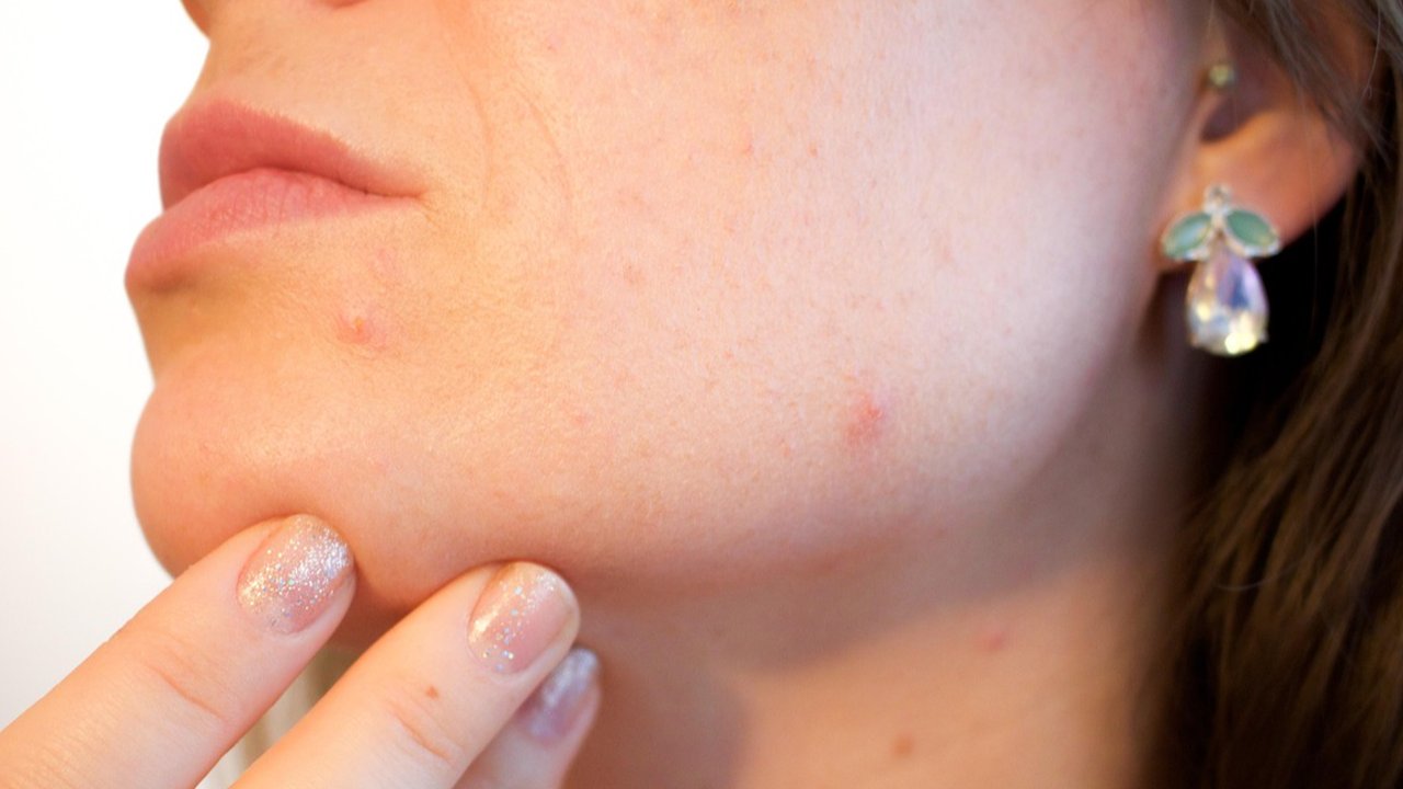 Mengapa orang dewasa masih menemukan jerawat yang bermunculan? Simak di sini alasannya. (iStockphoto)