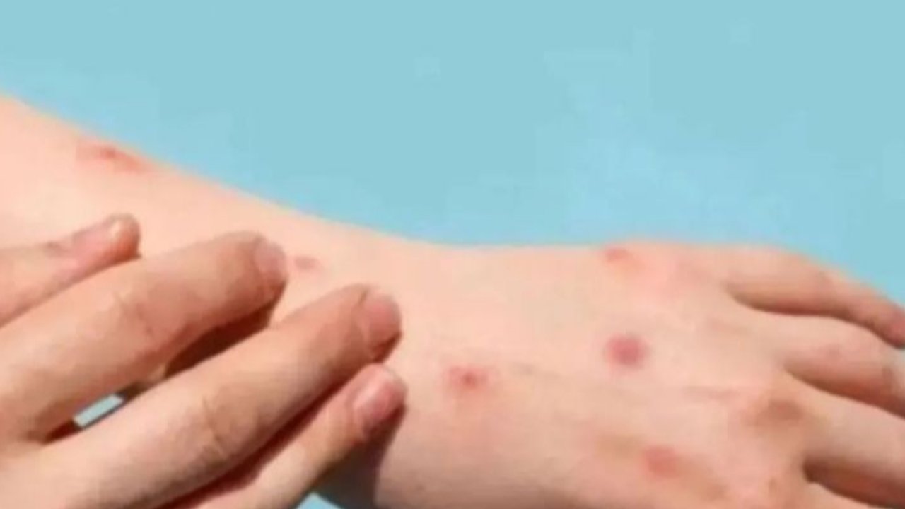 Seorang santri di Kepulauan Meranti meninggal dunia setelah diduga terinfeksi cacar monyet. Kenali gejala dan langkah antisipasi penyebaran virus ini.