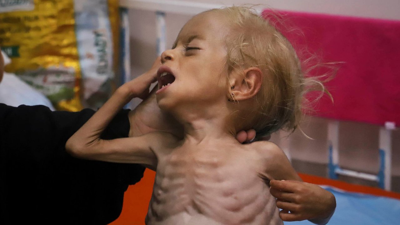 Balita Gaza Shamm Qudeih menerima perawatan medis dari Dr. Margherita Rosa di Rumah Sakit Anak Santobono Pausilipon di Naples, Italia selatan, Selasa (02/09/2025)