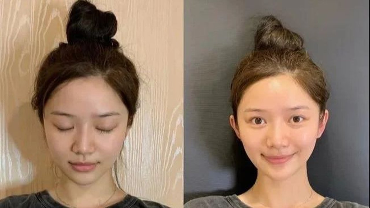 Di China, Sedang Trend Telinga Peri yang Menonjol dan Dianggap Salah Satu Simbol Kecantikan