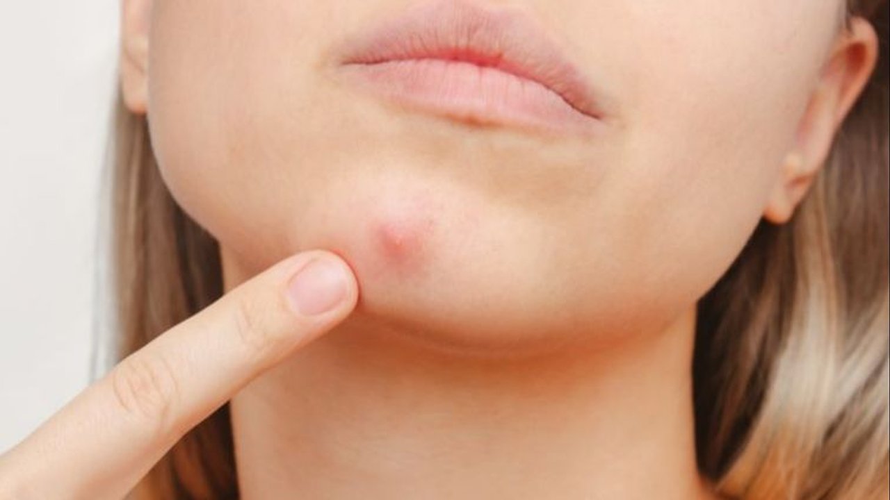 9 Cara Sederhana Menghilangkan Bekas Jerawat Membandel, Wajah Mulus Seketika