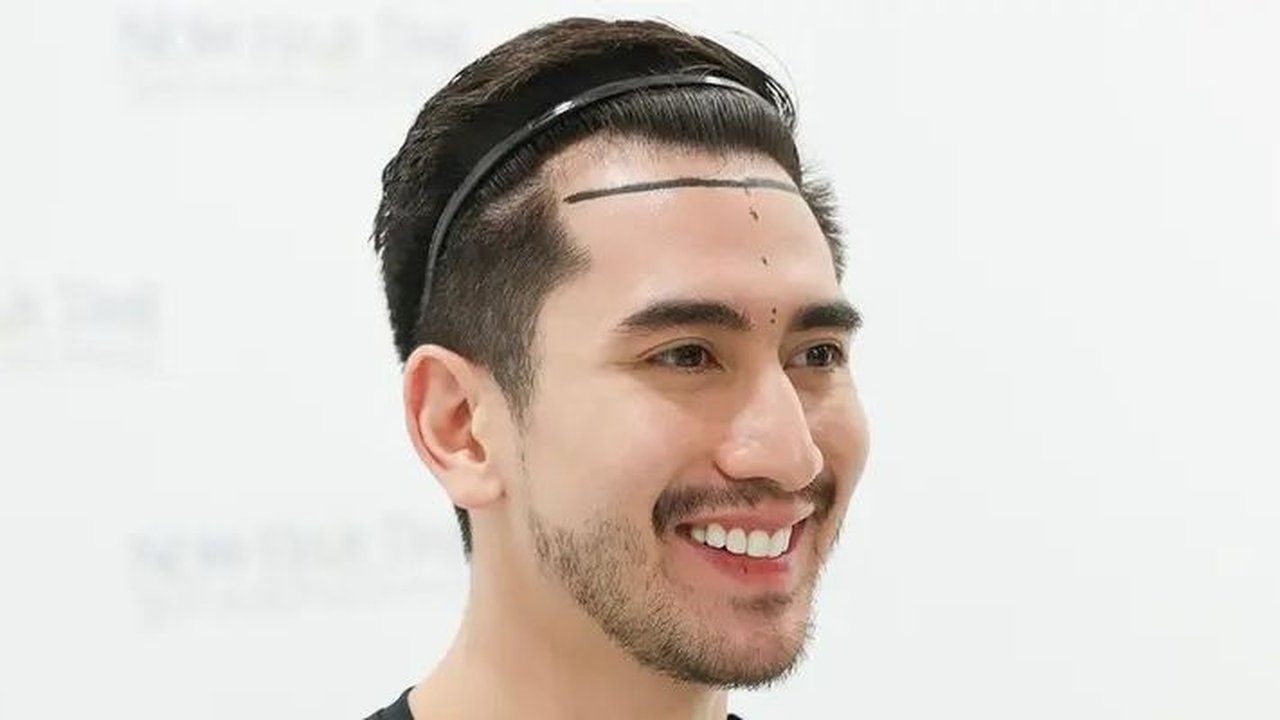 Verrell Bramasta Ungkap Pengalaman Transplantasi Rambut, Tampil Botak!