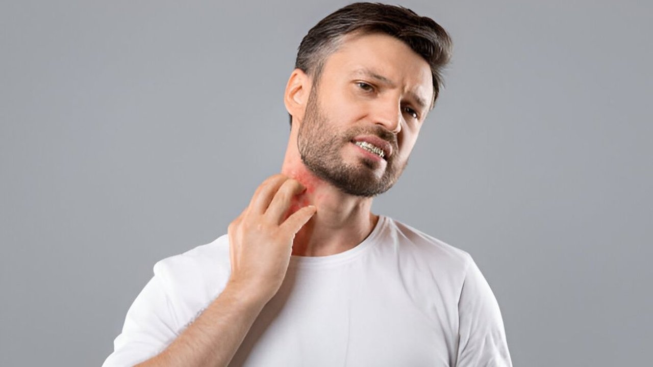 5 Penyebab Herpes di Leher, Begini Cara Mengatasinya