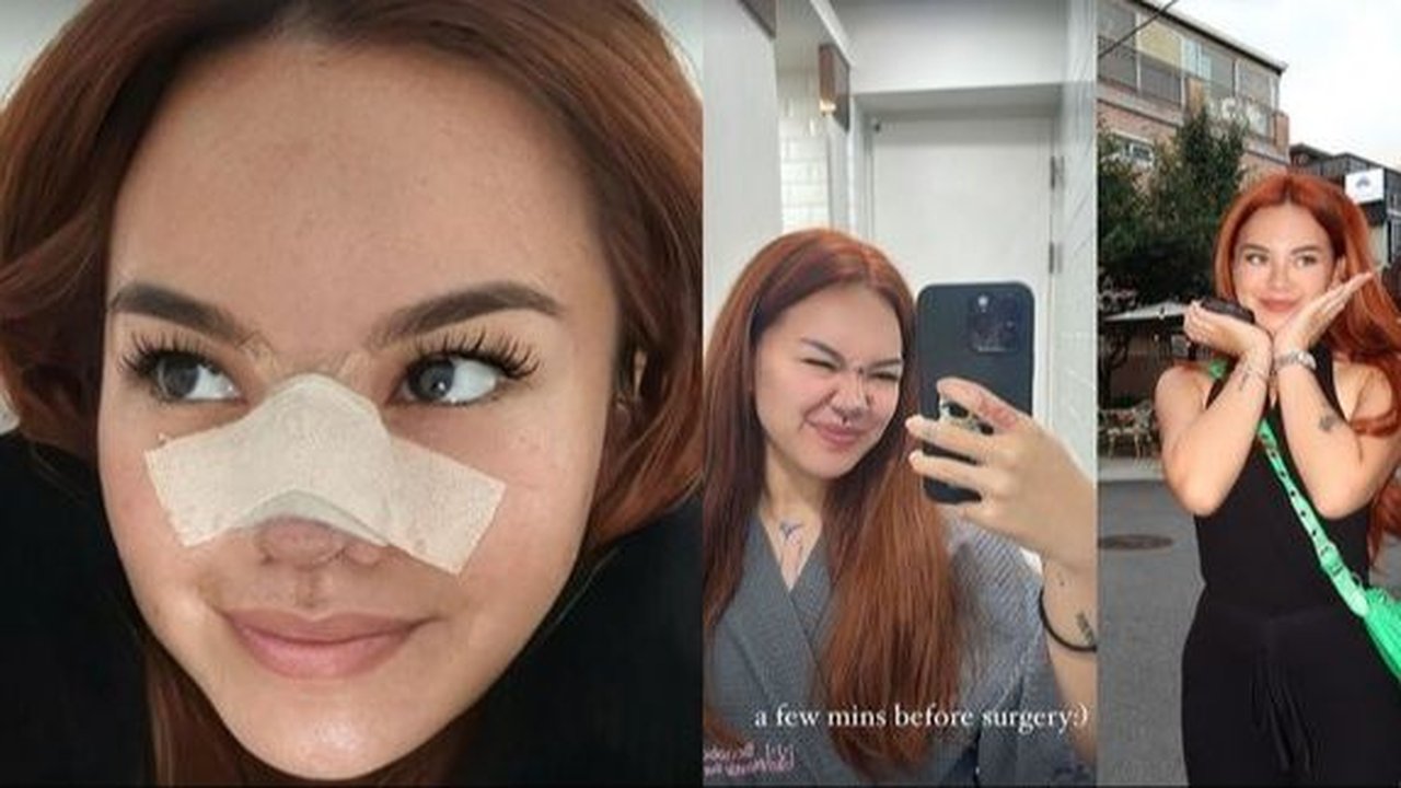 Potret Shafa Harris Oplas Hidung di Korea Selatan, Ambil Tulang dari Iga dan Wajah Minim Bengkak