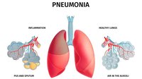 Lima Langkan Cegah Peradanngan Paru-paru Akibat Pneumonia