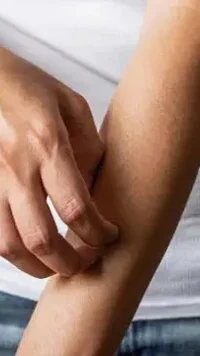 Cara Ampuh Menghilangkan Gatal Akibat Bulu Ulat Tanpa Obat, Bisa Dicoba