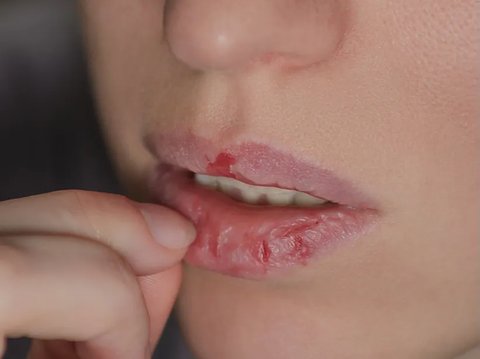 Bibir adalah lapisan paling tipis di area kulit lainnya dan lebih mudah kering. Bibir juga nggak memiliki kemampuan untuk menghasilkan kelembapannya sendiri.