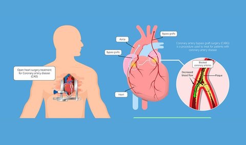 Diperuntukkan Pengidap Penyakit Jantung Koroner