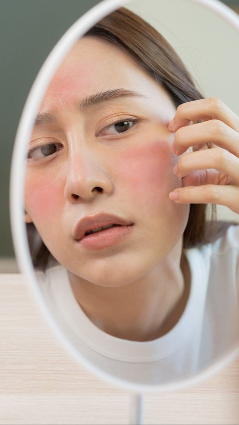 Jangan Cuma Cover dengan Makeup, Ini Solusi Hilangkan Kemerahan pada Wajah