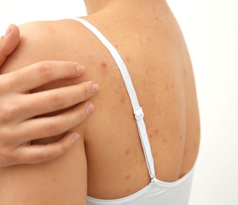 Tips for Taking Care of Your Back to Prevent Acne