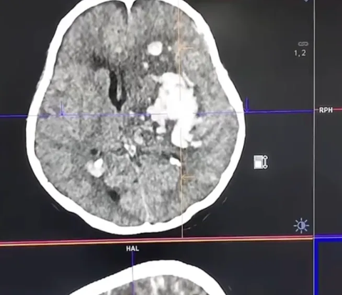 CT Scan Penggila Kopi dan Bergadang Bikin Takut Warganet, Usia 30 Pendarahan Otak